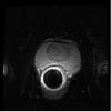 Bias Field Correction in Endorectal Diffusion Imaging