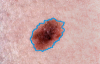 Skin Cancer Detection